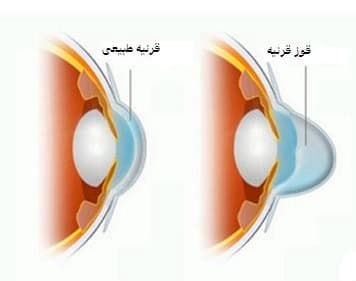 پاورپوینت بیماری قوز قرنیه یا کراتوکونوس