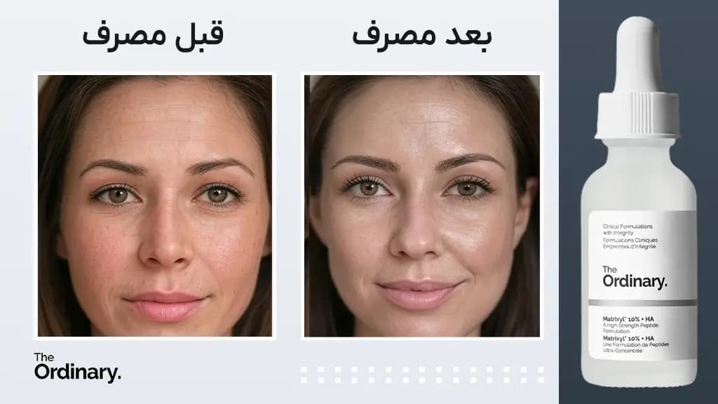 سرم ماتریکسیل ۱۰٪ اوردینری — تصویر ۴