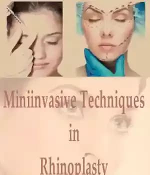 دانلود کتاب Miniinvasive Techniques in Rhinoplasty – تکنیک های کوچک تهاجمی در جراحی جراحی