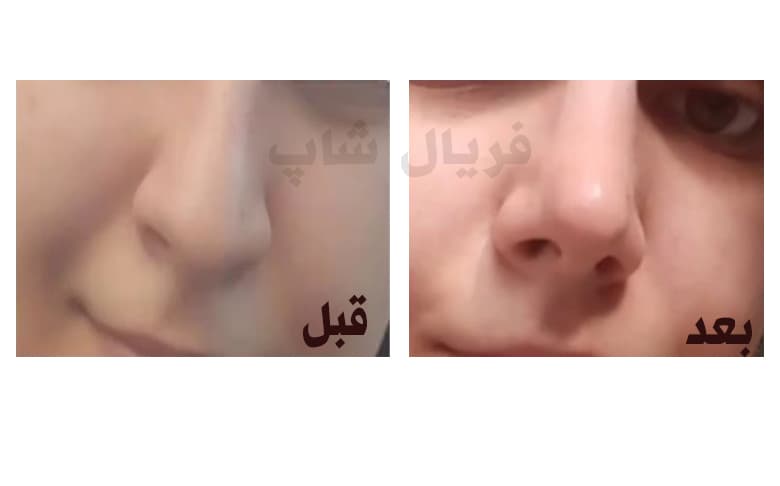 چسب لیفت و فرم دهنده بینی مدل بی رنگ (نامرئی) — تصویر ۳