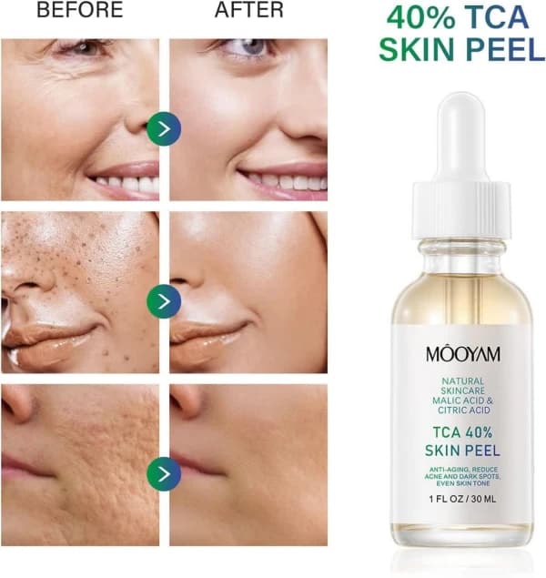 سرم لایه بردار TCA 40% مویام 30 میل — تصویر ۳