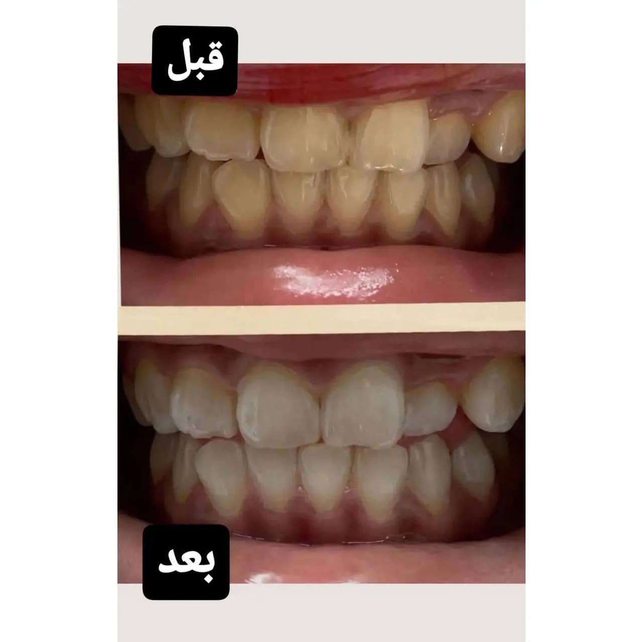 خمیر دندان سفیدکننده های اسمایل مدل V-34 — تصویر ۴