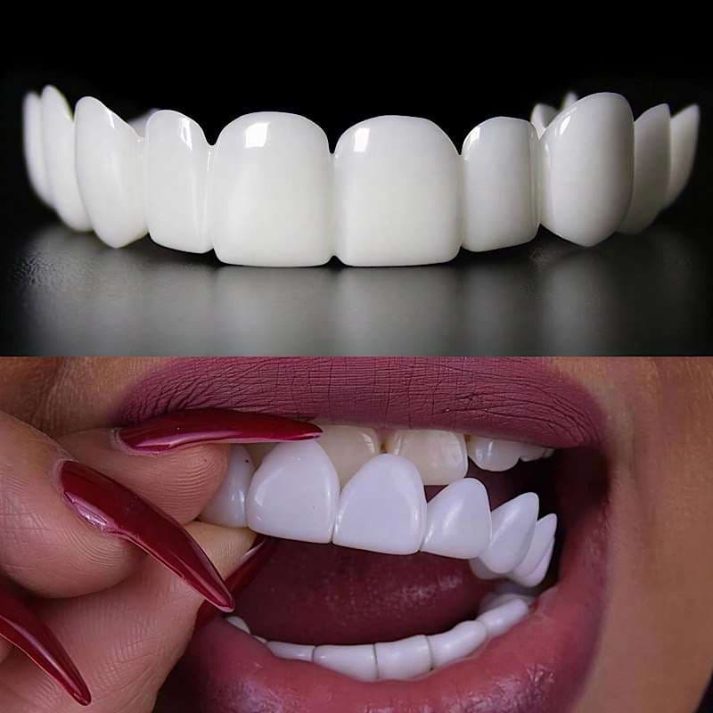 لمینت دندان دو فک مدل Snap on Smile کد N694 — تصویر ۳