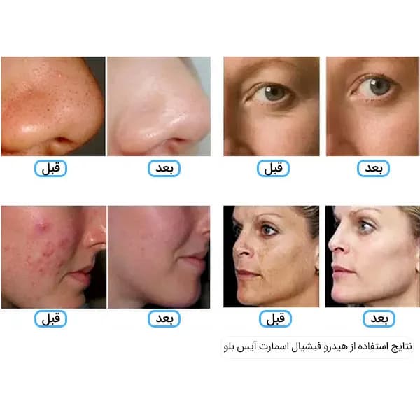 دستگاه هیدروفیشیال آیس بلو جوبی jobi — تصویر ۲