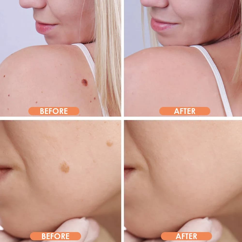دستگاه بیوتی پن 9 قدرته MOLE REMOVAL PEN — تصویر ۳