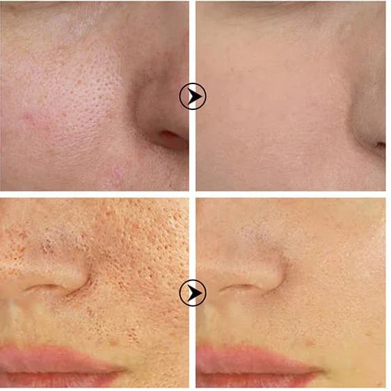 سرم کوچک کننده منافذ پوست بریلی Breylee حجم 17 میل — تصویر ۵