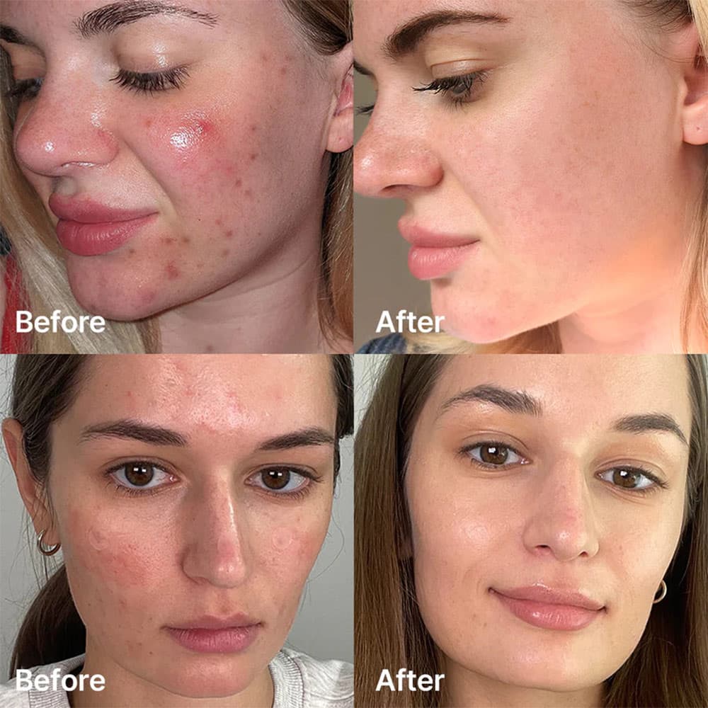 سرم ضد جوش سوکسینیک اسید مدیکیوب Medicube Red Succinic Acid Serum مناسب پوست چرب، مختلط و مستعد آکنه حجم40 میلی لیتر — تصویر ۴