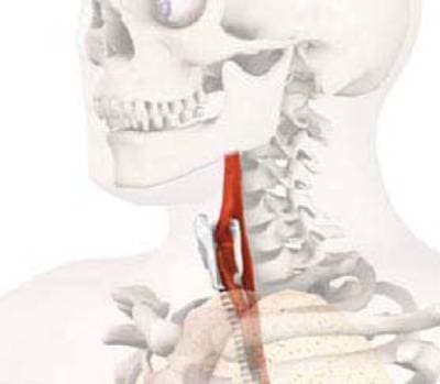 کتاب Cancer of the Larynx: Current Concepts in the Treatment of the Neck (ORL) نسخه کامل