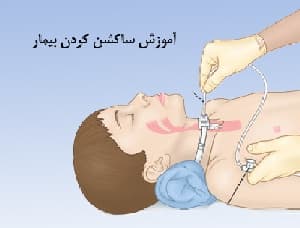 پاورپوینت آموزش ساکشن کردن راه هوایی به خانواده بیمار