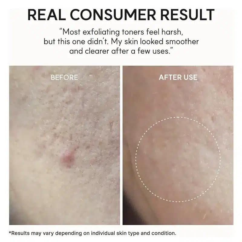 تونر لایه بردار گلیکولیک اسید و سالیسیلیک اسید آرنسیا Arencia مدل Eraser Shot Glycolic Acid Exfoliator (200 میل) — تصویر ۴