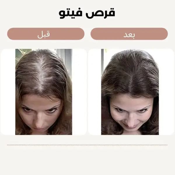 قرص اصل ایتالیایی- تقویت کننده و ضد ریزش مو هورمونی و ارثی — تصویر ۲