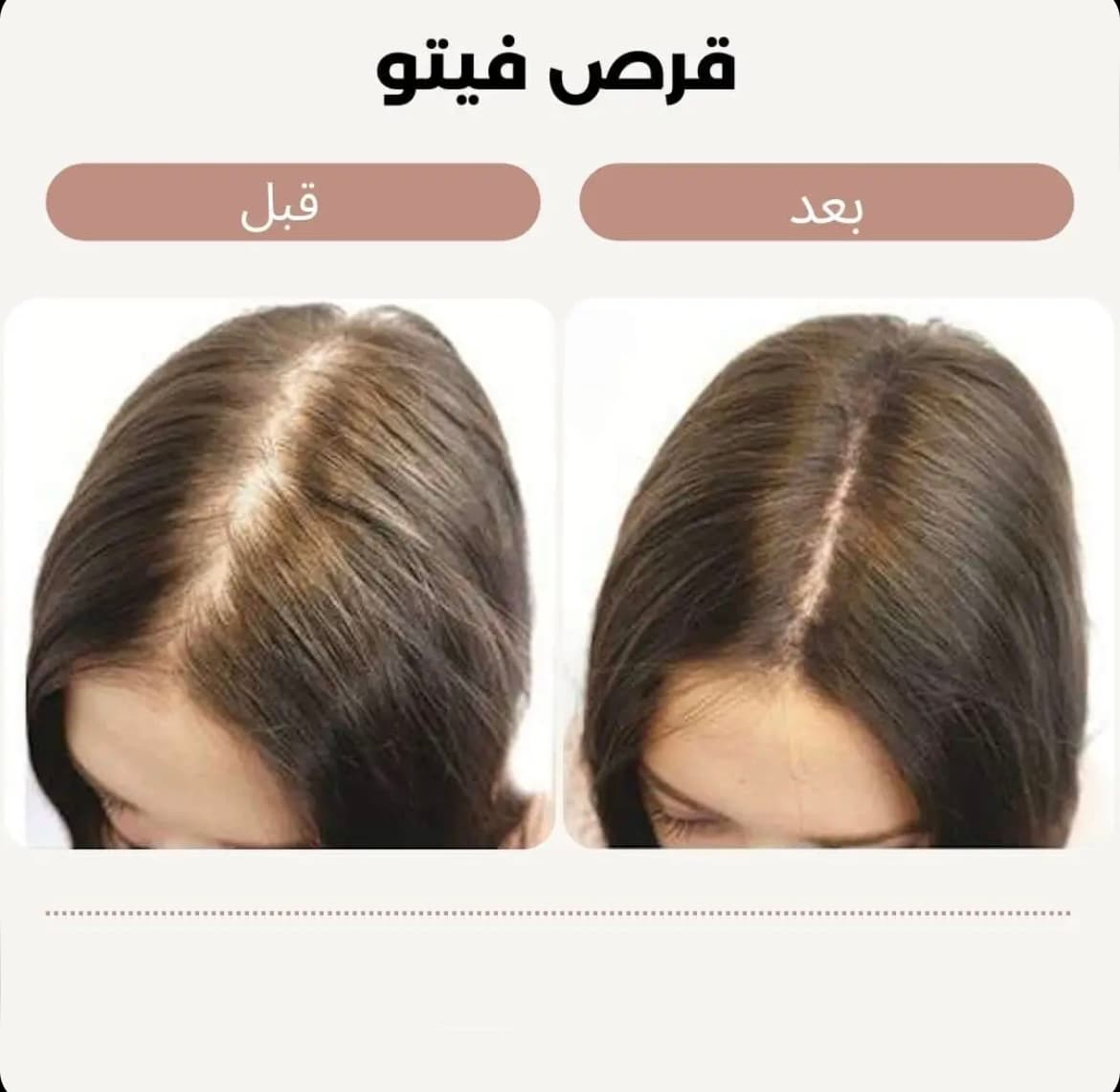 قرص اصل ایتالیایی- تقویت کننده و ضد ریزش مو هورمونی و ارثی — تصویر ۴