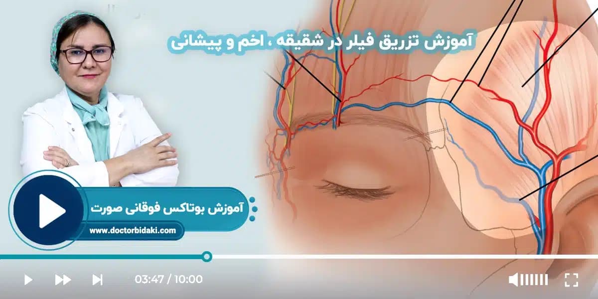مینی دوره تزریق فیلر شقیقه و پیشانی دکتر بیدکی