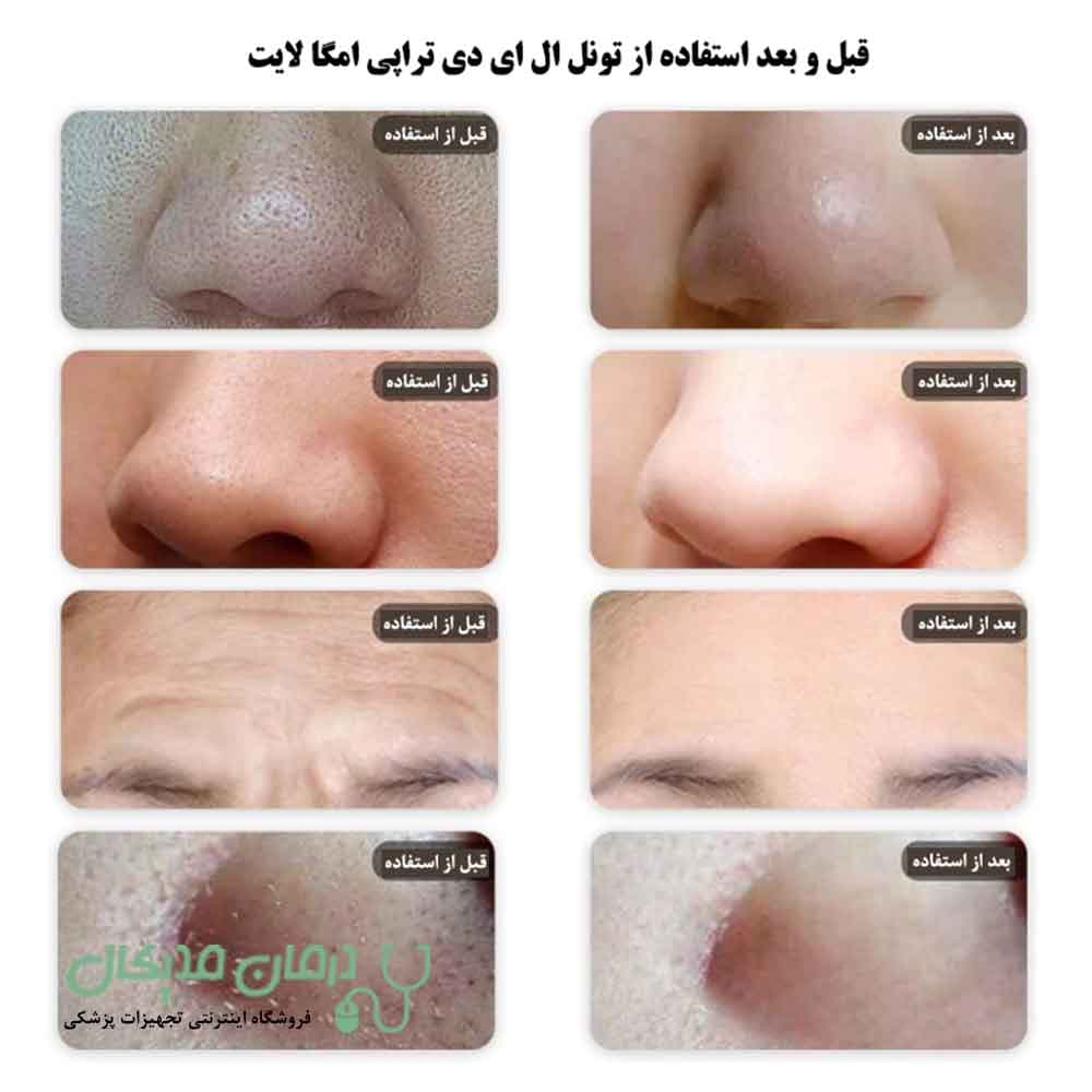 تونل ال ای دی تراپی امگا لایت — تصویر ۶