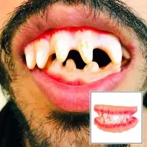 دندان مصنوعی دراکولا لثه‌ای جفتی — تصویر ۲