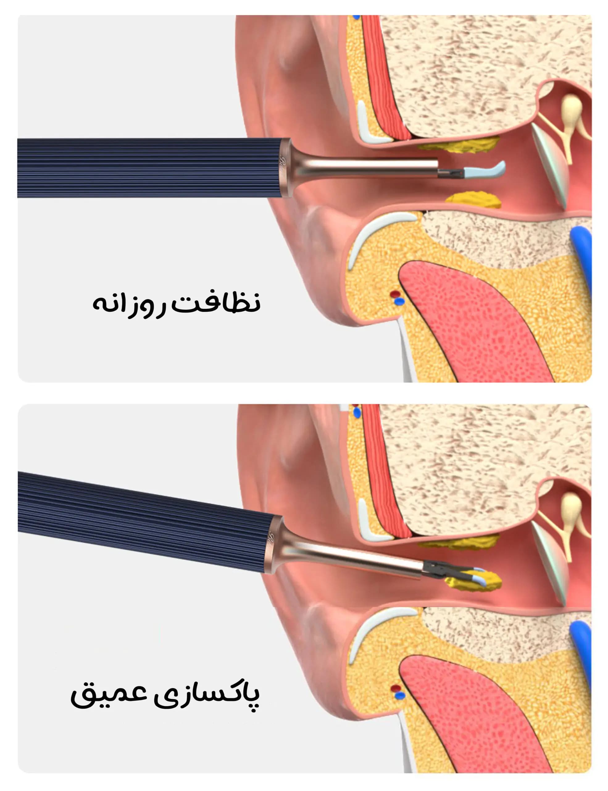 گوش‌ پاک‌کن هوشمند شیائومی Bebird مدل Note 3 Pro Max سرمه ای — تصویر ۷