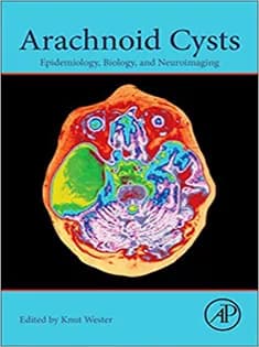 دانلود کتاب Arachnoid Cysts: Epidemiology, Biology, and Neuroimaging