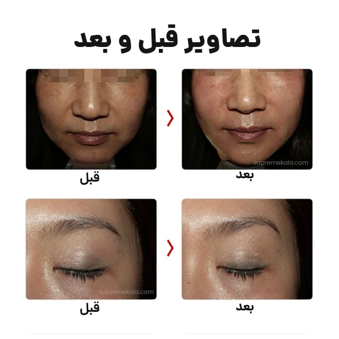 دستگاه هایفو دابلو گلد – Hifu Gold Premium — تصویر ۹