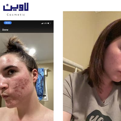 فوم شستشو صورت پوست نرمال تا چرب سراوی 473 میل — تصویر ۶