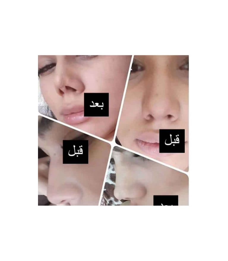چسب لیفت بینی بی رنگ (نامرئی) — تصویر ۳