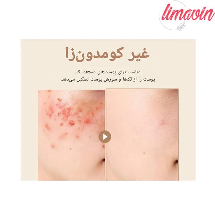 ژل کرم تسکین دهنده جو دوسر پیوریتو حجم 100 میلی لیتر — تصویر ۵
