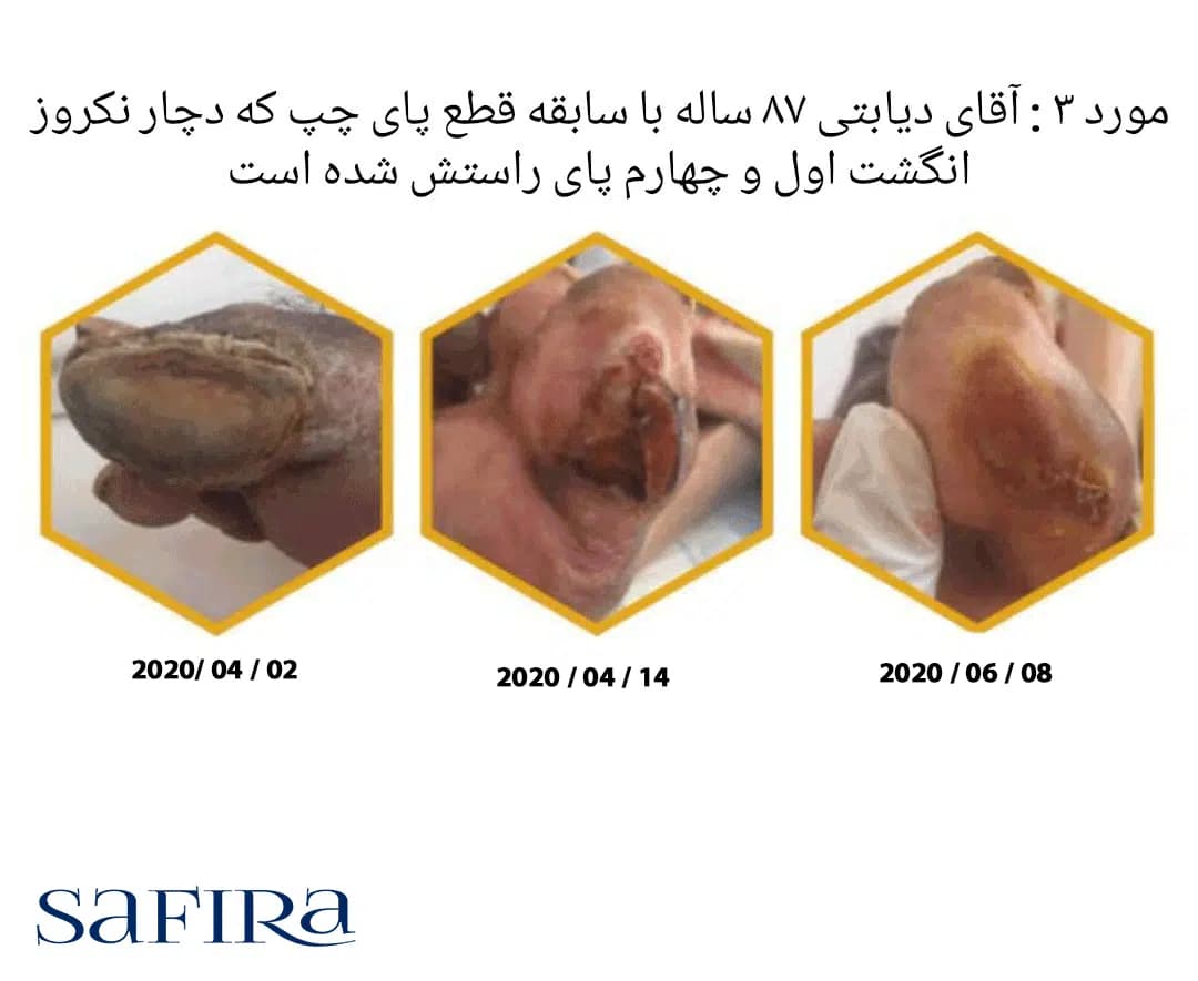 پماد عسل آنتی باکتریال مدی هانی کد 405 — تصویر ۵