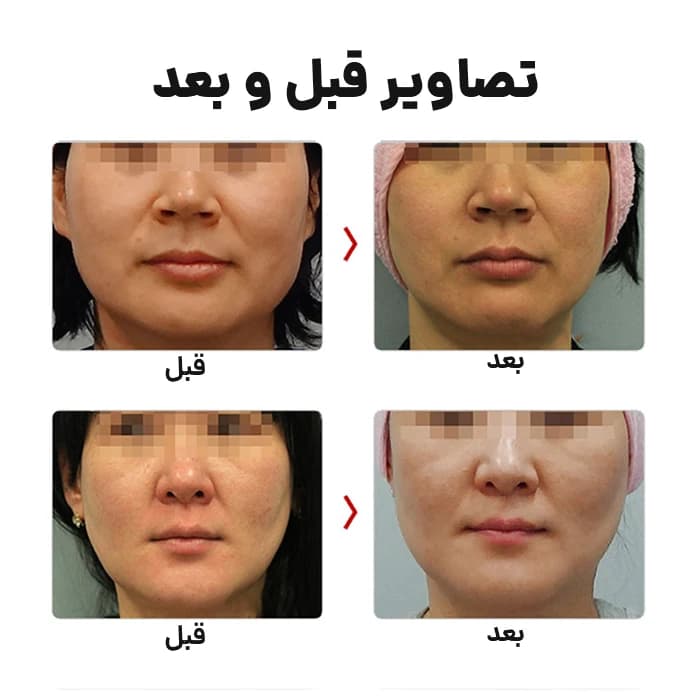 دستگاه هایفو گلد پریمیوم – Haifu Gold Premium — تصویر ۸