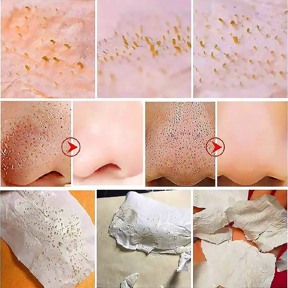 چسب بینی ضد جوش سر سیاه لانبنا — تصویر ۹