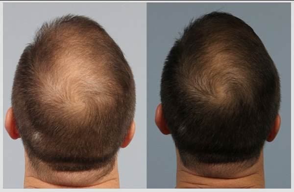 پک 10 عددی کوکتل مزولایک هیرمن Hairman حجم 10 میل — تصویر ۳