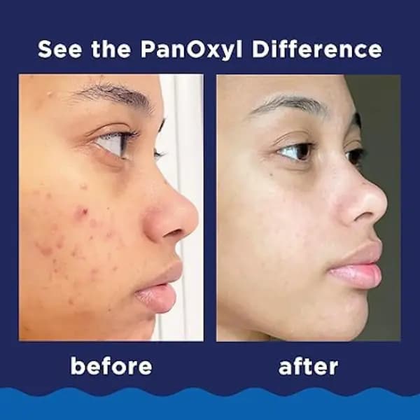 فوم شوینده ضد جوش پانوکسیل panoxyl حاوی بنزوئیل پراکسید 10% — تصویر ۴