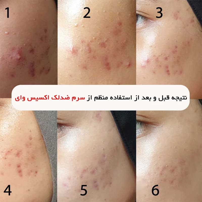 کرم لایه بردار و کنترل منافذ اکسیس وای AXIS-Y LHA — تصویر ۴