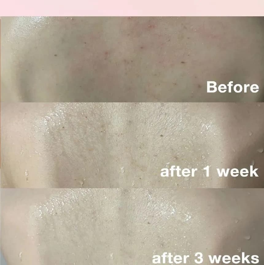 شوینده بدن ضد آکنه قرمز مدی کیوب 400 گرم Medicube Red Acne Body Wash — تصویر ۵