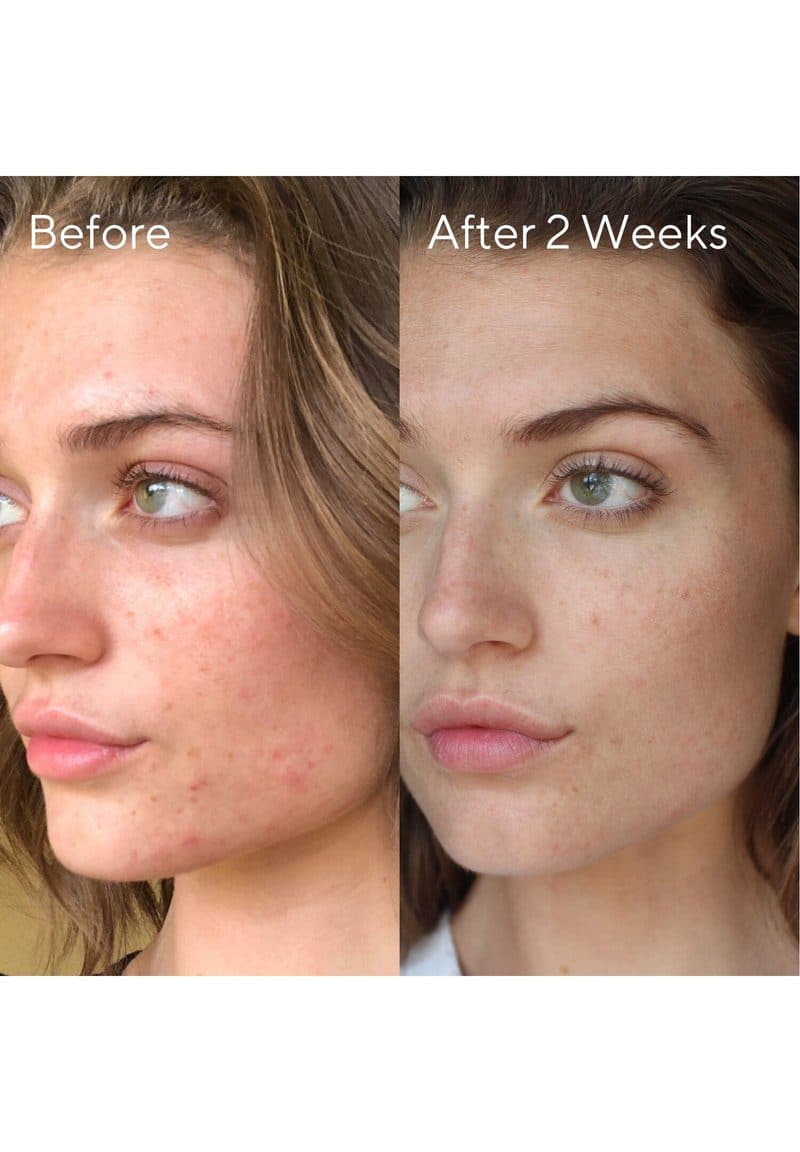 کرم ضد لک آکنه مورد 30میل Murad Invisiscar Resurfacing Treatment — تصویر ۳