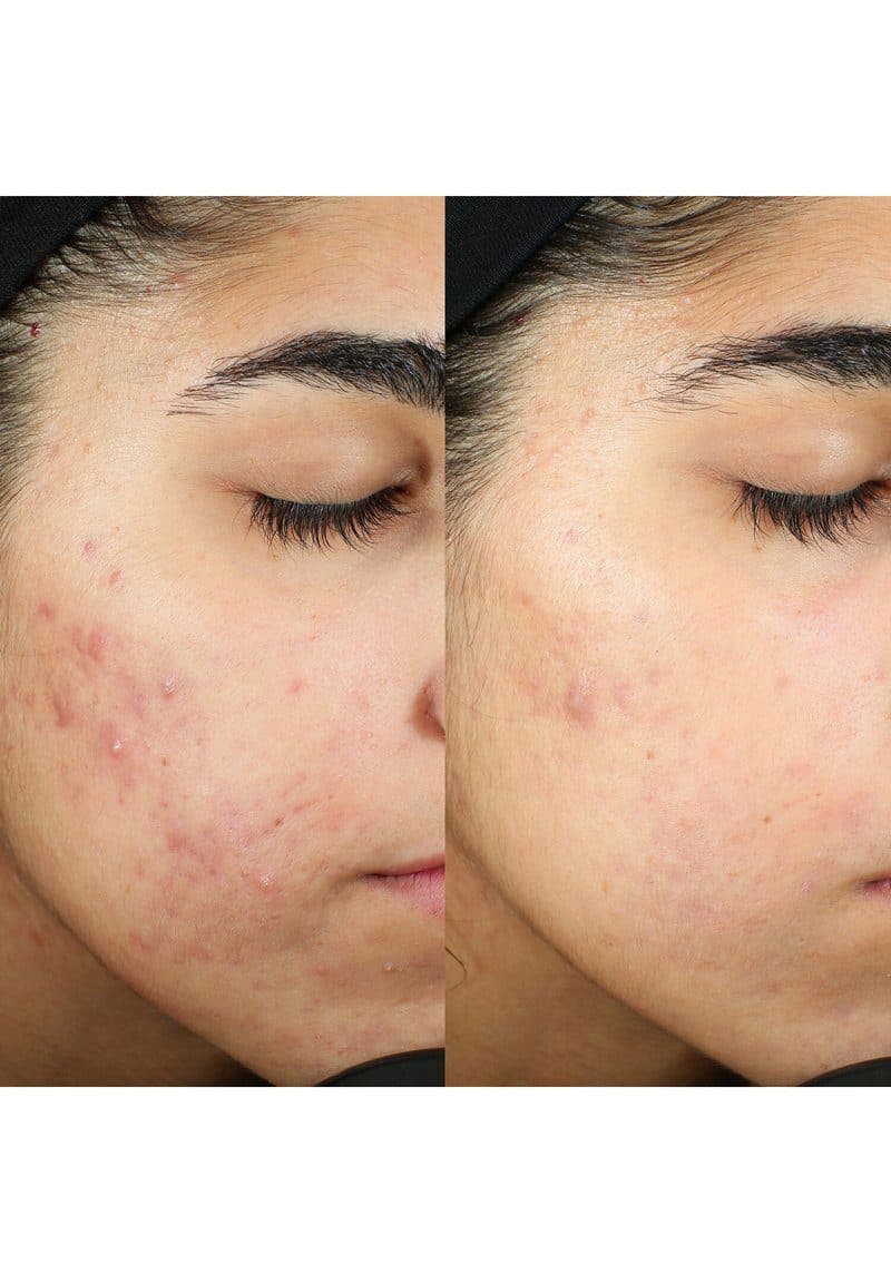 کرم ضد لک آکنه مورد 30میل Murad Invisiscar Resurfacing Treatment — تصویر ۴