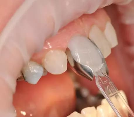 قالب پیش ساخته کامپوزیت بزرگ U Veneer Extra برند Ultradent — تصویر ۷