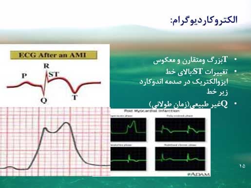 پاورپوینت درباره سکته قلبی ( انفارکتوس میوکارد ) — تصویر ۴