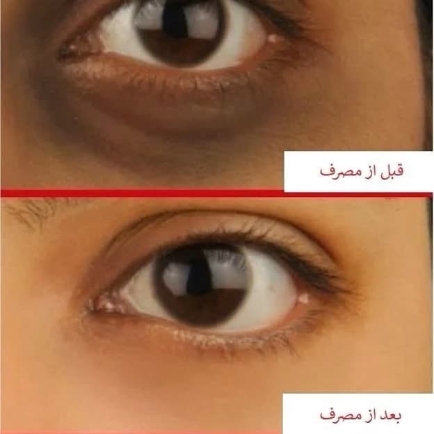 دور چشم ACM دپی وایت برطرف کننده تخصصی تیرگی و لک چشم کد 1876 — تصویر ۳