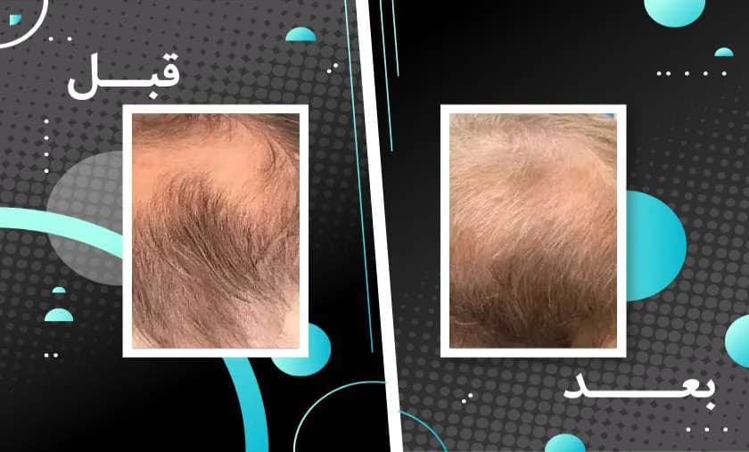 کپسول تقویت مو و ناخن فیتو فانر بسته 120 عددی — تصویر ۳