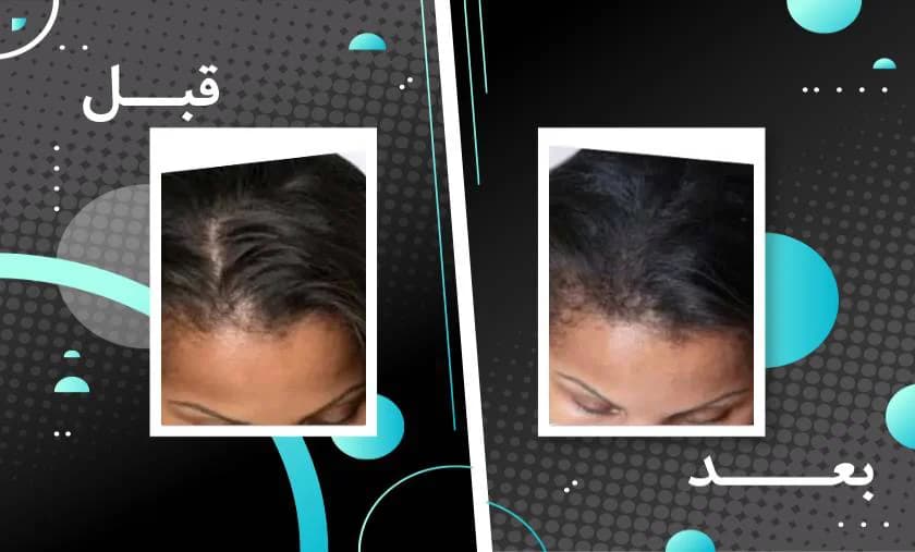 کپسول تقویت مو و ناخن فیتو فانر بسته 120 عددی — تصویر ۸