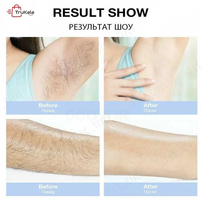 لیزر موهای زائد دائمی و حرفه ای 900 هزار شات ( پالس ) IPL — تصویر ۶