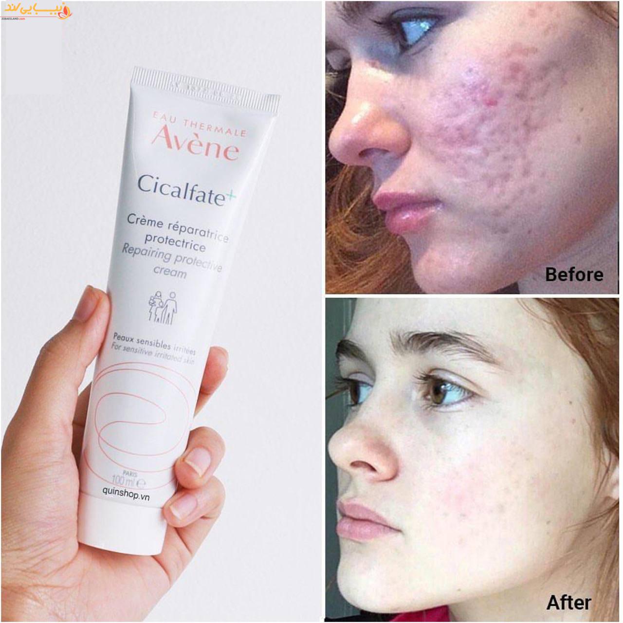کرم ترمیم کننده پوست سیکالفیت پلاس اون Avene حجم 100میل — تصویر ۴