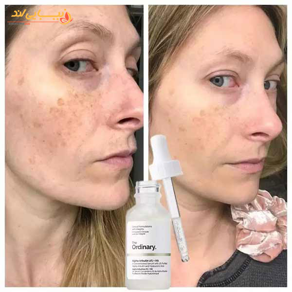 سرم ضد لک آلفا آربوتین 2% اوردینری The Ordinary — تصویر ۳