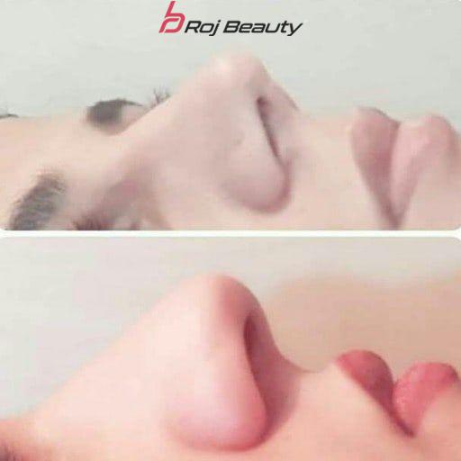 چسب لیفت بینی باریک اصل کره — تصویر ۶