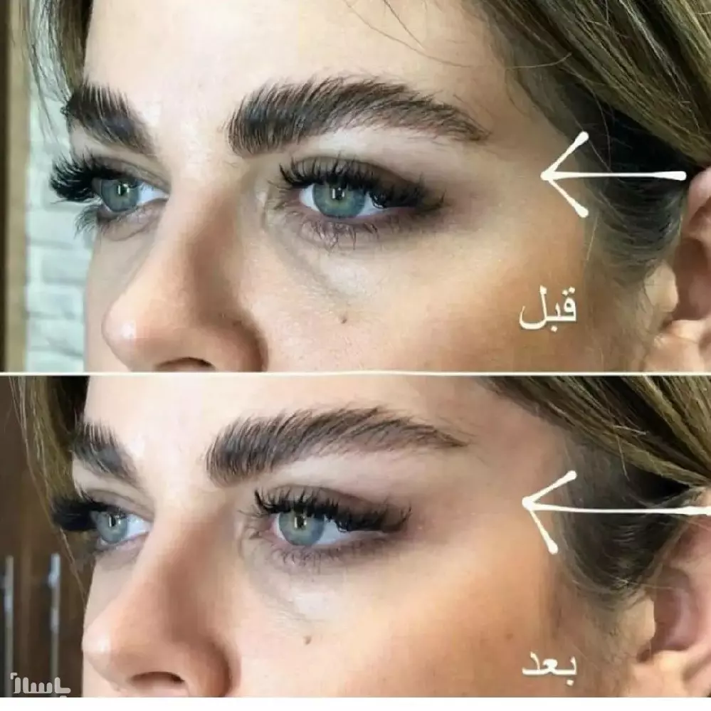 کش لیفت شقیقه، گونه و ابرو — تصویر ۳