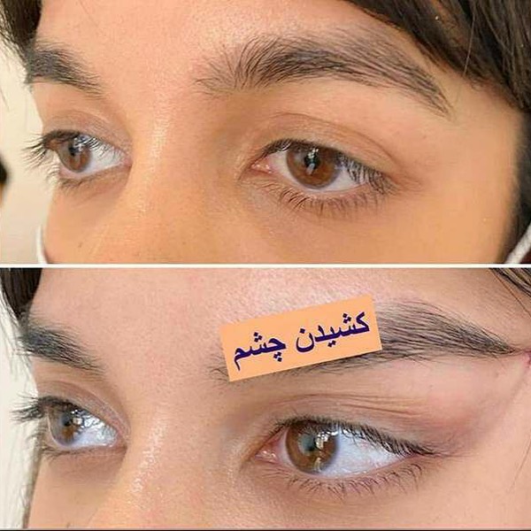 کش لیفت شقیقه، گونه و ابرو — تصویر ۸