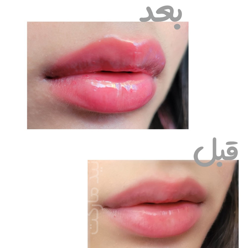 حجم دهنده لب آمپولی کیس بیوتی — تصویر ۸